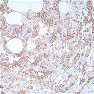 E-cadherin (EP700Y) on breast carcinoma