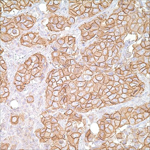Her2/Neu (c-erB-2) (CB-11) on breast carcinoma