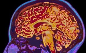 Colored MRI image of brain