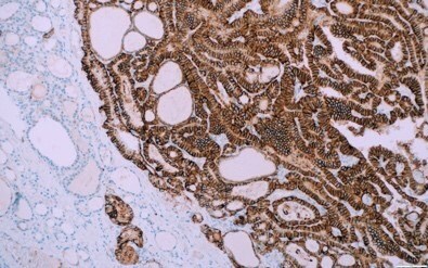 利用Cell Marque™ TROP2 (EP431)抗体和复染剂对乳头状甲状腺癌进行IHC染色