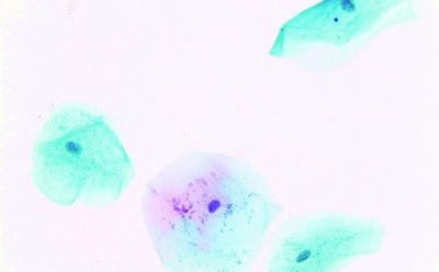 阴道分泌物样本的巴氏染色，显示脱落细胞的细胞核与细胞质着色的特征范围。
