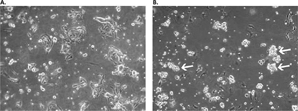 Appearance of primary culture of lung squamous cell carcinoma cells in the Primary Cancer Cell Medium D-ACF in early stages.