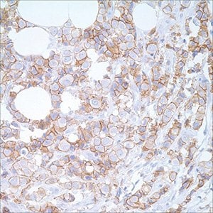 E-cadherin (EP700Y) on breast carcinoma