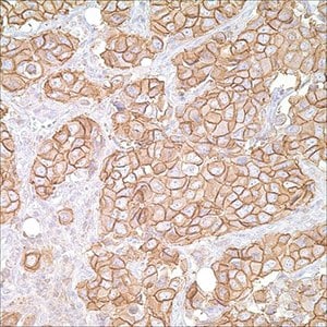 Her2/Neu (c-erB-2) (CB-11) on breast carcinoma