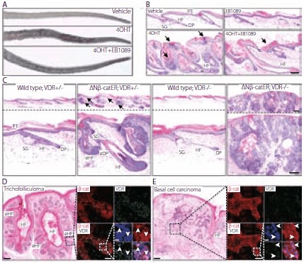 VDR modulates β-catenin induced skin tumors
