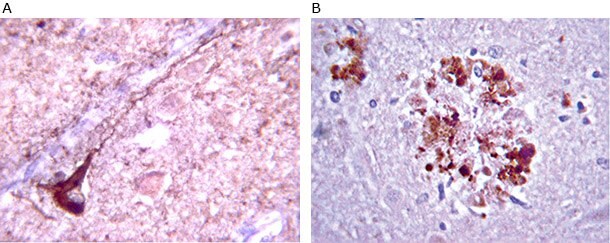 <b>A)</b> Anti-β-Amyloid antibody staining (MAB348) staining on Alzheimer’s diseased cells. Immunoreactivity is seen as staining on plaque deposits (dark brown). <b>B)</b> Anti-Phospho Tau staining (AB9668) of Alzheimer’s diseased cells. Immunoreactivity is clearly not nuclear and it follows the length of the neuron’s axon. Anti-β-Amyloid antibody staining