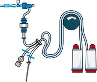 Steritest® NEO过滤套筒 For medical devices and collapsible bags., Red base canister provided with 3 needle adapters to connect to a variety of test devices., pkg of 10 blisters per box, Single packed